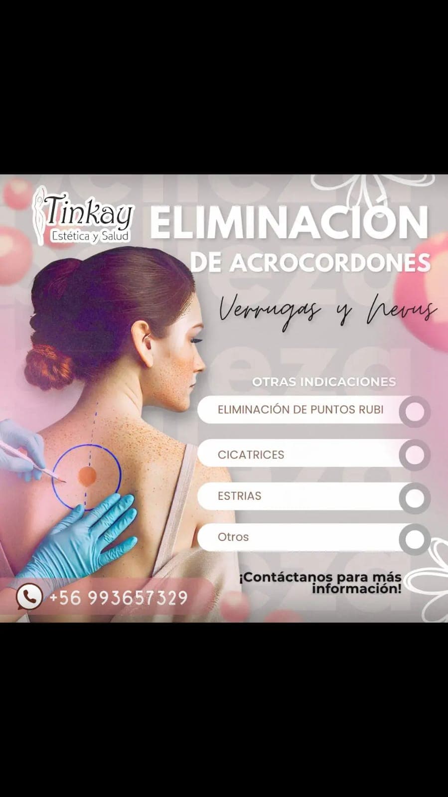 Plasma Pen Fibroblast